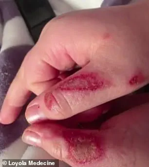 Nine-Year-Old Suffers Severe Burns After Microwaving Sensory Toy in Viral TikTok Trend