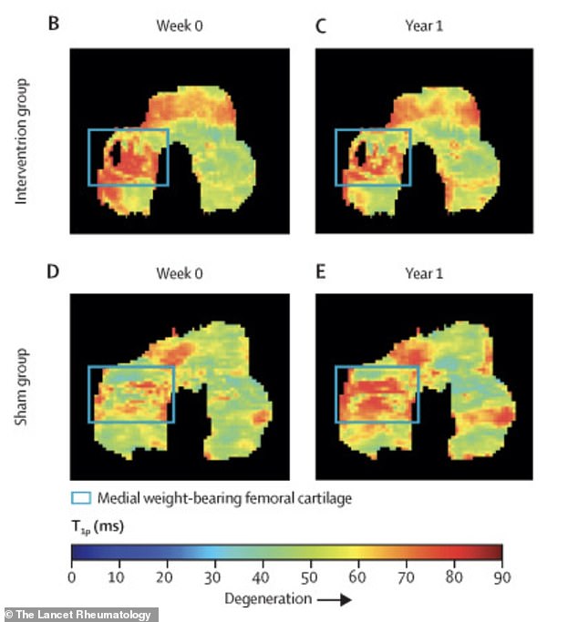 Stanford Study Shows Simple Walking Adjustment Can Ease Knee Arthritis Pain