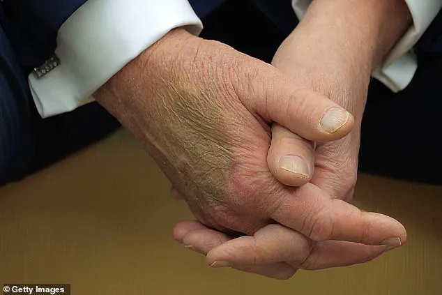Trump's Hand Bruise Sparking Concerns Online: Dehydration or More?