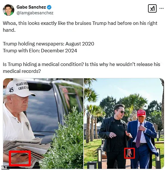 Trump's Hand Bruise Sparking Concerns Online: Dehydration or More?