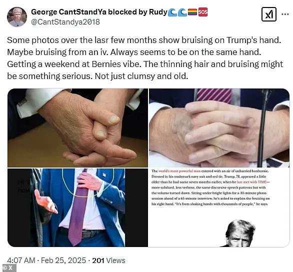 Trump's Hand Bruise Sparking Concerns Online: Dehydration or More?